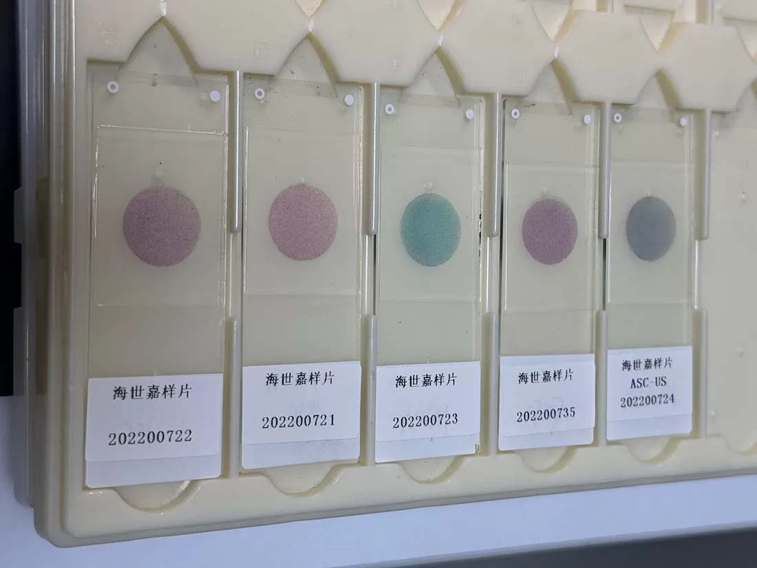 Como interpretar os resultados da mancha de Papanicolaou corretamente